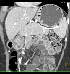 Unusual Islet Cell Tumor in Head of Pancreas - CTisus CT Scan