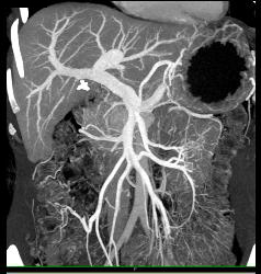 Unusual Islet Cell Tumor in Head of Pancreas - CTisus CT Scan