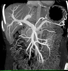 Unusual Islet Cell Tumor in Head of Pancreas - CTisus CT Scan