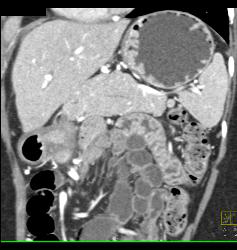 Unusual Islet Cell Tumor in Head of Pancreas - CTisus CT Scan