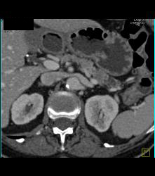 Subtle Carcinoma in Body of Pancreas Obstructing the Pancreatic Duct - CTisus CT Scan