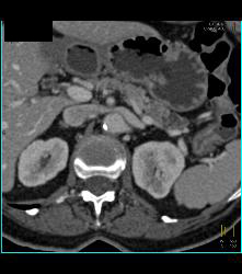 Subtle Carcinoma in Body of Pancreas Obstructing the Pancreatic Duct - CTisus CT Scan