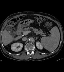 Subtle Carcinoma in Body of Pancreas Obstructing the Pancreatic Duct - CTisus CT Scan