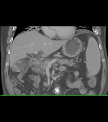 Subtle Carcinoma in Body of Pancreas Obstructing the Pancreatic Duct - CTisus CT Scan