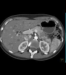 Serous Cystadenoma - CTisus CT Scan