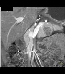 Serous Cystadenoma - CTisus CT Scan