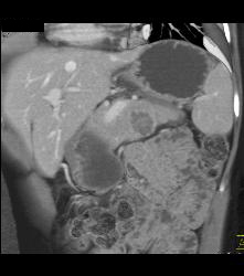 Serous Cystadenoma - CTisus CT Scan