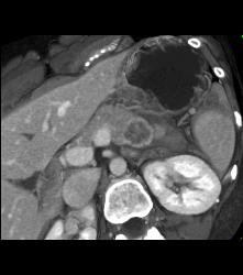 Serous Cystadenoma - CTisus CT Scan