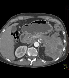 Islet Cell Tumor Tail of Pancreas - CTisus CT Scan