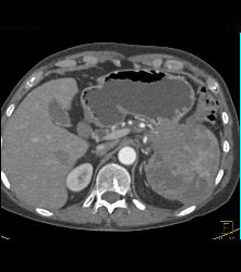 Islet Cell Tumor Tail of Pancreas - CTisus CT Scan