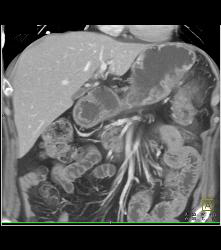 Islet Cell Tumor Tail of Pancreas - CTisus CT Scan