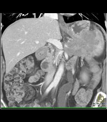 Islet Cell Tumor Tail of Pancreas - CTisus CT Scan