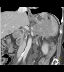 Islet Cell Tumor Tail of Pancreas - CTisus CT Scan