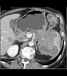 Islet Cell Tumor Tail of Pancreas - CTisus CT Scan