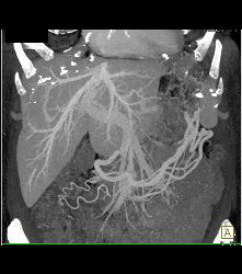 Islet Cell Tumor Tail of Pancreas - CTisus CT Scan