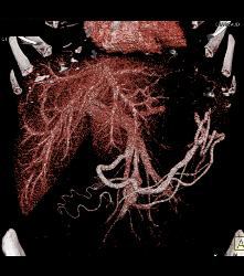 Islet Cell Tumor Tail of Pancreas - CTisus CT Scan