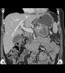 Pancreatic Adenocarcinoma Occludes the Splenic Vein - CTisus CT Scan