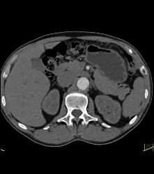 Splenule Simulates An Islet Cell Tumor - CTisus CT Scan