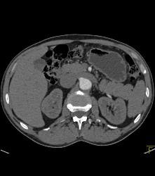 Splenule Simulates An Islet Cell Tumor - CTisus CT Scan