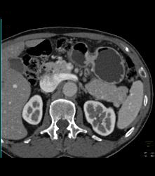 Splenule Simulates An Islet Cell Tumor - CTisus CT Scan