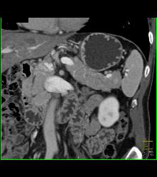 Splenule Simulates An Islet Cell Tumor - CTisus CT Scan