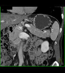 Splenule Simulates An Islet Cell Tumor - CTisus CT Scan