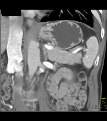 Splenule Simulates An Islet Cell Tumor - CTisus CT Scan