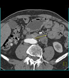 Intraductal Papillary Mucinous Neoplasm (IPMN) - CTisus CT Scan