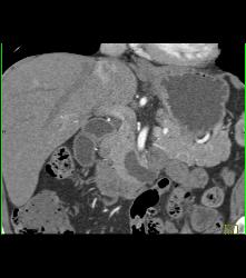 Intraductal Papillary Mucinous Neoplasm (IPMN) - CTisus CT Scan