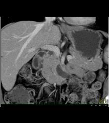 Intraductal Papillary Mucinous Neoplasm (IPMN) - CTisus CT Scan