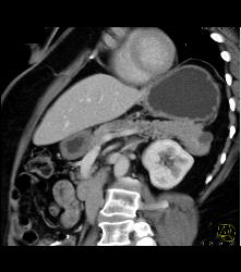 Intraductal Papillary Mucinous Neoplasm (IPMN) - CTisus CT Scan