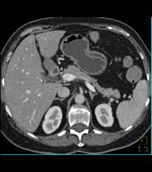 Subtle Carcinoma Body of Pancreas - CTisus CT Scan