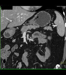 Subtle Carcinoma Body of Pancreas - CTisus CT Scan