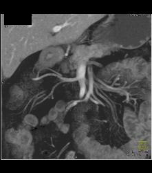 Subtle Carcinoma Body of Pancreas - CTisus CT Scan