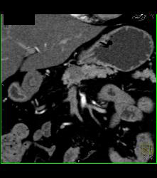 Subtle Carcinoma Body of Pancreas - CTisus CT Scan