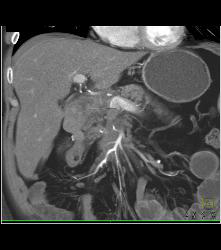 Tumor Encases the SMA - CTisus CT Scan