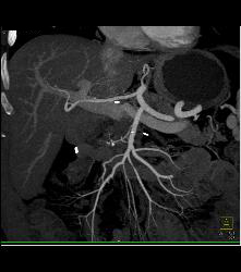 Tumor Encases the SMA - CTisus CT Scan