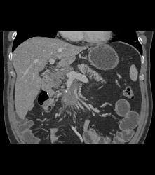 Tumor Encases the SMA - CTisus CT Scan