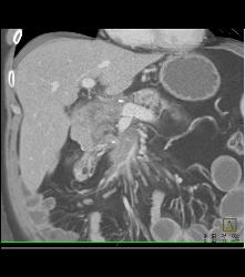 Tumor Encases the SMA - CTisus CT Scan