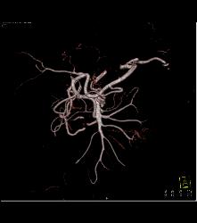 Tumor Encases the SMA - CTisus CT Scan