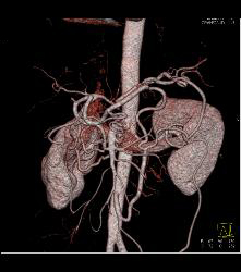 Tumor Encases the SMA - CTisus CT Scan