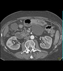 Pseudocyst - CTisus CT Scan