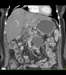 Pseudocyst - CTisus CT Scan