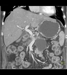 Pseudocyst - CTisus CT Scan