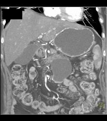 Pseudocyst - CTisus CT Scan