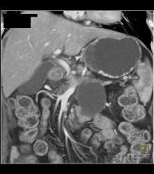 Cystadenoma - CTisus CT Scan