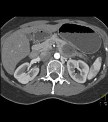 SPEN Tumor - CTisus CT Scan