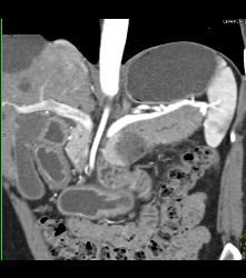 SPEN Tumor - CTisus CT Scan