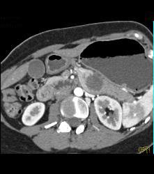 SPEN Tumor - CTisus CT Scan