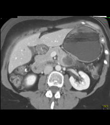 SPEN Tumor - CTisus CT Scan